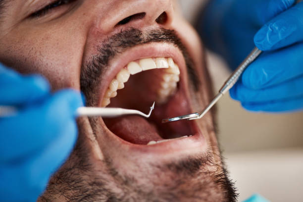 Best Emergency Dentist for Lost Fillings or Crowns in Kennesaw, GA